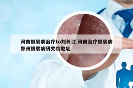 河南银屑病治疗to刘长江 河南治疗银屑病郑州银屑病研究院地址