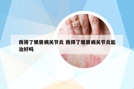 我得了银屑病关节炎 我得了银屑病关节炎能治好吗