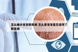 怎么确诊宝宝银屑病 怎么查宝宝是否遗传了银屑病