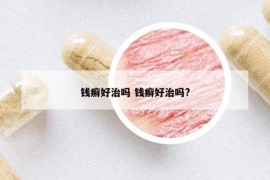 钱癣好治吗 钱癣好治吗?