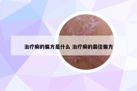 治疗癣的偏方是什么 治疗癣的最佳偏方