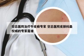 空总医院治疗牛皮癣专家 空总医院皮肤科最权威的专家是谁