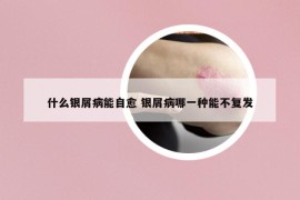 什么银屑病能自愈 银屑病哪一种能不复发