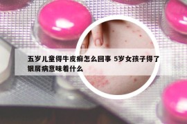 五岁儿童得牛皮癣怎么回事 5岁女孩子得了银屑病意味着什么