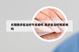 长期跑步能治好牛皮癣吗 跑步能治好银屑病吗