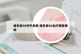 维生素b6对牛皮癣 维生素b6治疗银屑病吗