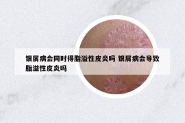 银屑病会同时得脂溢性皮炎吗 银屑病会导致脂溢性皮炎吗