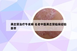 龚志贤治疗牛皮癣 名老中医龚志贤临床经验荟萃