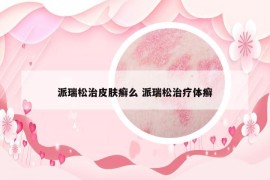 派瑞松治皮肤癣么 派瑞松治疗体癣