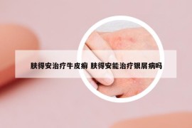 肤得安治疗牛皮癣 肤得安能治疗银屑病吗