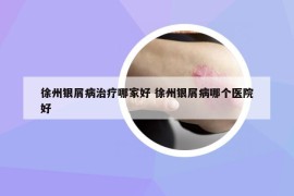 徐州银屑病治疗哪家好 徐州银屑病哪个医院好