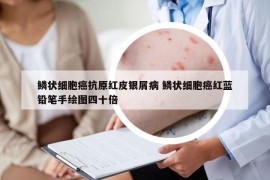 鳞状细胞癌抗原红皮银屑病 鳞状细胞癌红蓝铅笔手绘图四十倍