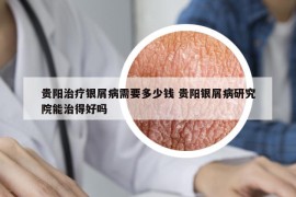 贵阳治疗银屑病需要多少钱 贵阳银屑病研究院能治得好吗