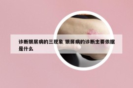 诊断银屑病的三现象 银屑病的诊断主要依据是什么