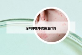 深圳哪里牛皮癣治疗好