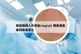 银屑病病人外周血rasgrp1 银屑病患者的血液变化