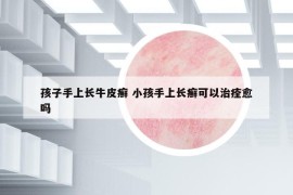 孩子手上长牛皮癣 小孩手上长癣可以治痊愈吗