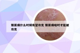 银屑病什么时候有望攻克 银屑病啥时才能被攻克