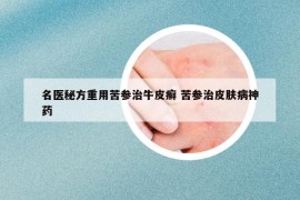 名医秘方重用苦参治牛皮癣 苦参治皮肤病神药