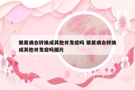 银屑病会转换成其他并发症吗 银屑病会转换成其他并发症吗图片