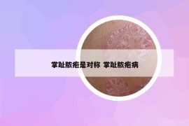 掌趾脓疱是对称 掌趾脓疱病