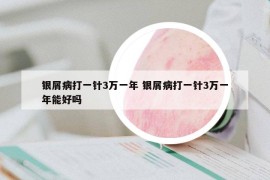 银屑病打一针3万一年 银屑病打一针3万一年能好吗