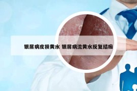 银屑病皮损黄水 银屑病流黄水反复结痂