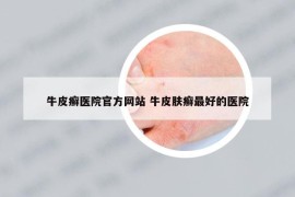 牛皮癣医院官方网站 牛皮肤癣最好的医院