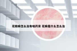 花般癣怎么治有啥药膏 花癣是什么怎么治