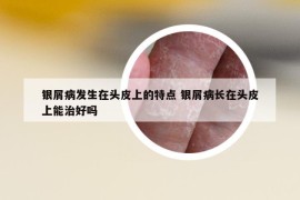 银屑病发生在头皮上的特点 银屑病长在头皮上能治好吗