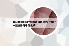 munro微脓肿能确诊银屑病吗 munro微脓肿见于什么病