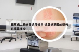 银屑病二级亲属遗传概率 银屑病基因的遗传几率是多少