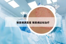 银屑病满意度 银屑病达标治疗