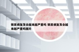 银屑病复发会越来越严重吗 银屑病复发会越来越严重吗图片