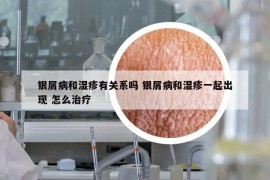 银屑病和湿疹有关系吗 银屑病和湿疹一起出现 怎么治疗