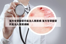 复方甘草酸苷片能治人银屑病 复方甘草酸苷片能治人银屑病嘛