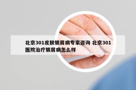 北京301皮肤银屑病专家咨询 北京301医院治疗银屑病怎么样