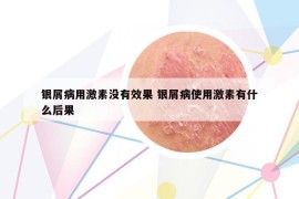 银屑病用激素没有效果 银屑病使用激素有什么后果