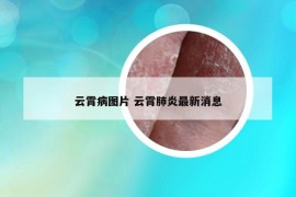 云霄病图片 云霄肺炎最新消息