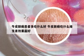 牛皮肤癣患者多吃什么好 牛皮肤癣吃什么维生素效果最好