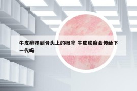 牛皮癣串到骨头上的概率 牛皮肤癣会传给下一代吗