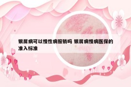 银屑病可以慢性病报销吗 银屑病慢病医保的准入标准