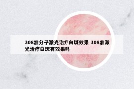 308准分子激光治疗白斑效果 308准激光治疗白斑有效果吗