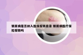 银屑病是否纳入医保报销目录 银屑病医疗保险报销吗