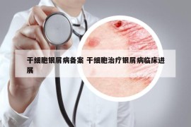 干细胞银屑病备案 干细胞治疗银屑病临床进展