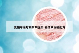 夏枯草治疗银屑病医案 夏枯草治癌配方