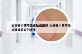 北京哪个医院治皮肤病最好 北京哪个医院治皮肤病最好的医生