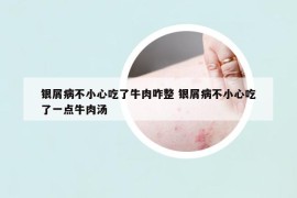 银屑病不小心吃了牛肉咋整 银屑病不小心吃了一点牛肉汤