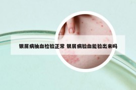 银屑病抽血检验正常 银屑病验血能验出来吗