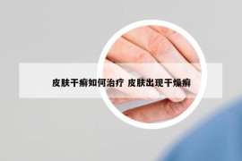 皮肤干癣如何治疗 皮肤出现干燥癣